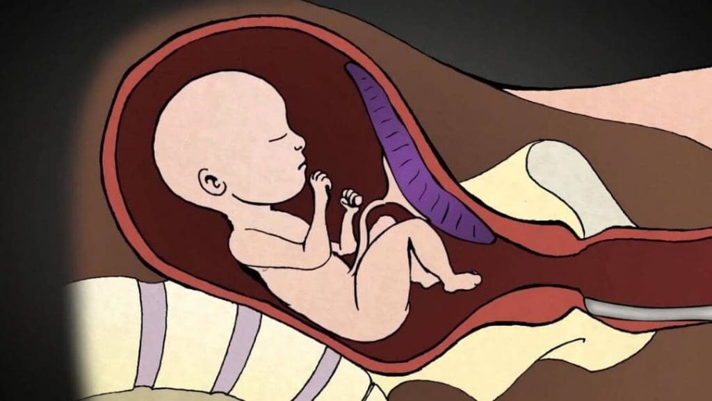 The 2nd Trimester Abortion Procedure (video)